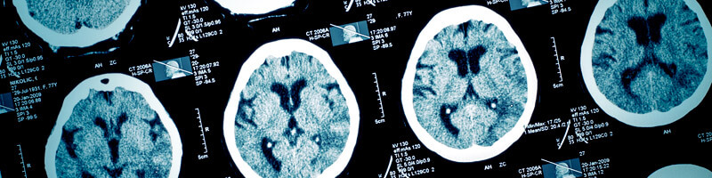 Las Lesiones en La Cabeza Pueden Conducir a Enfermedades Cerebrales Serias